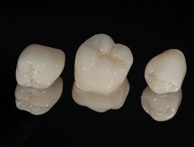 A set of three dental crowns, all made from non-metal materials