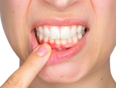 Woman pointing to inflamed gum tissue.
