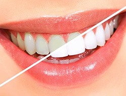 Before and after of teeth whitening in Toledo