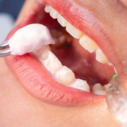 Closeup of foam fluoride being applied to someone’s teeth
