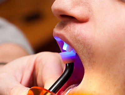 Young woman having a tooth cured