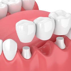 illustration traditional dental bridge in Toledo   