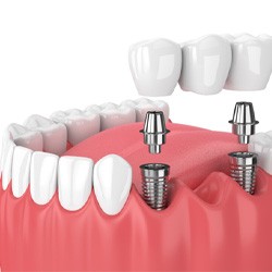 illustration implant dental bridge in Toledo   