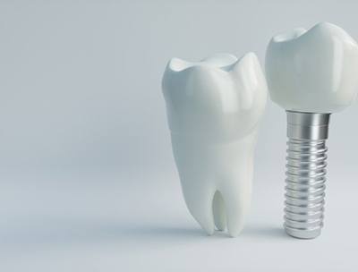 dental implant with a crown next to a natural tooth