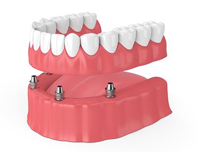 implant-retained denture on bottom arch 