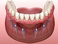 Diagram of an implant denture in Toledo