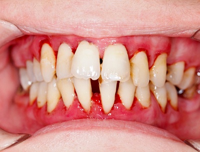 Image of a mouth with gum disease.