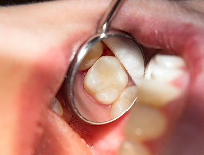 A dental mirroring revealing a tooth-colored filling in a tooth.
