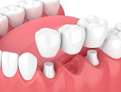 A diagram of a dental bridge.