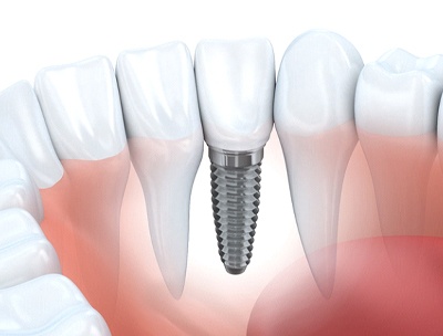 A diagram of a dental implant.