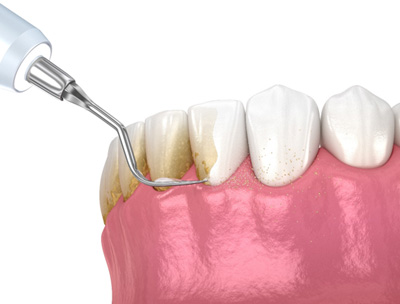 Illustration of scaling and root planing for lower arch