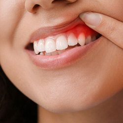 Woman pulling up lip to show inflamed gums