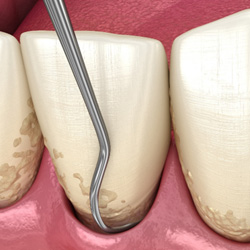 Illustration of teeth during scaling and root planing