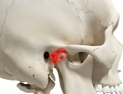 Arthritis pain in TMJ