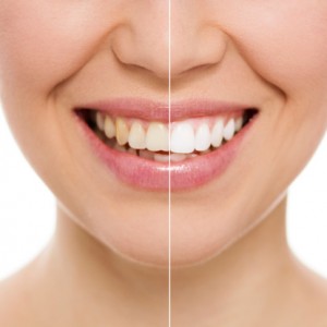 Teeth whitening at home or in our office is great.