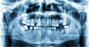 x-ray photo of teeth and jawbone