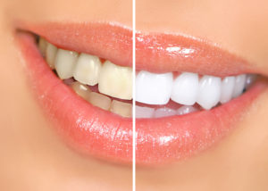 woman showing before and after whitening