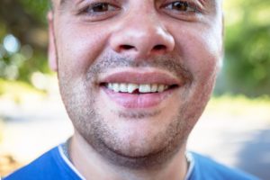 man with a chipped tooth