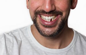 Man with a missing lower front tooth