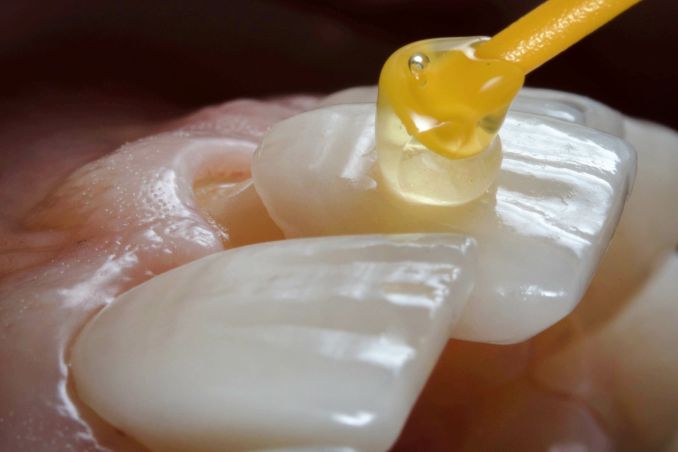 Teeth having veneers attached to them