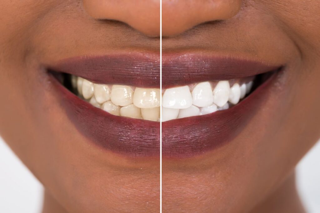 A before and after photo of a woman who had professional teeth whitening