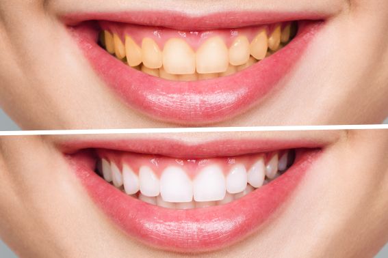 A smile before and after professional teeth whitening treatment